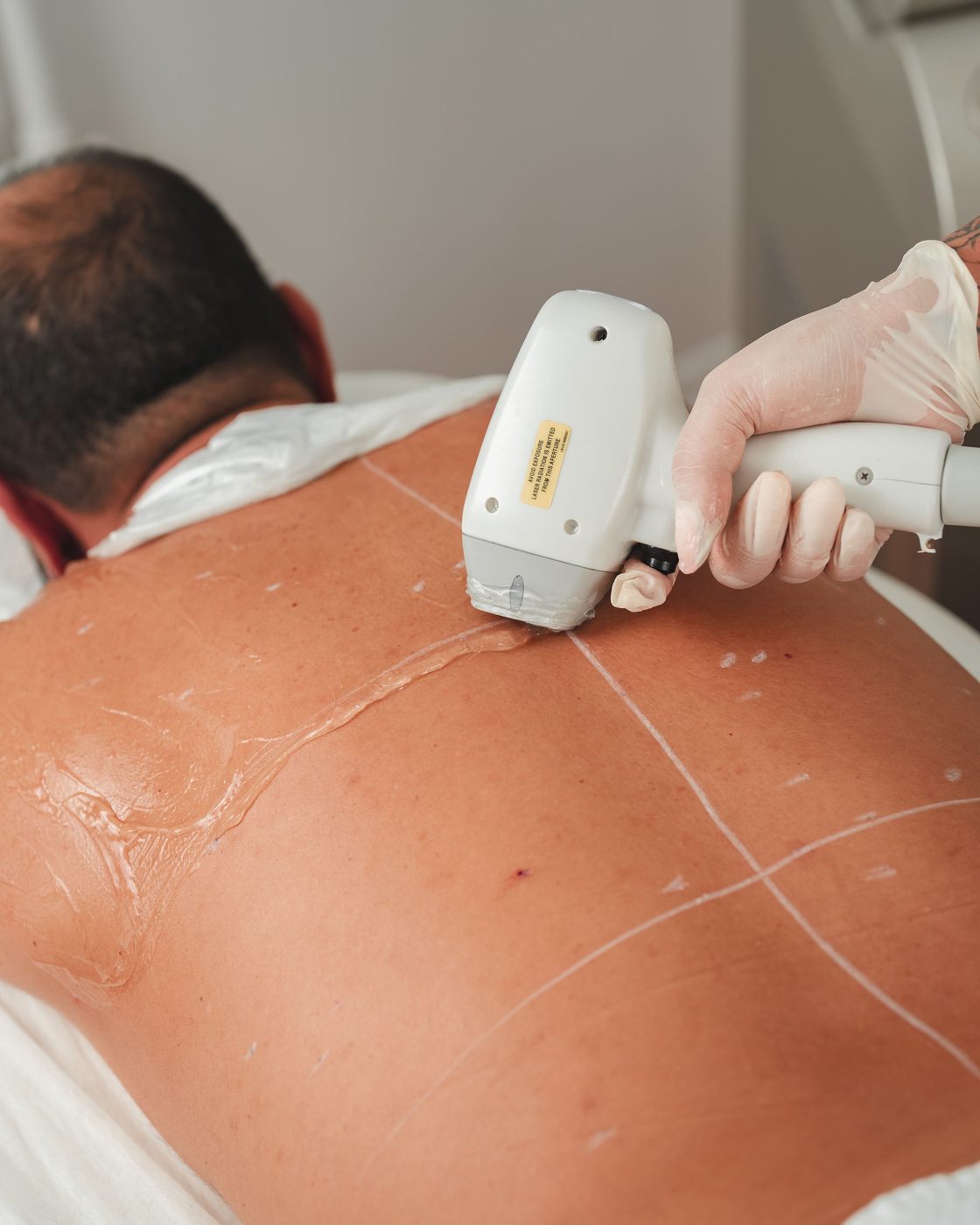 Depilación láser en zona de espalda masculina